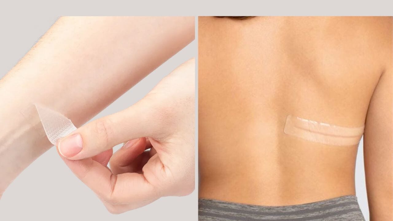 Scar tape, silicone based, applied on two different body areas