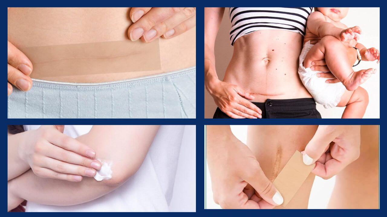 Different ways of using scar gel and scar tape